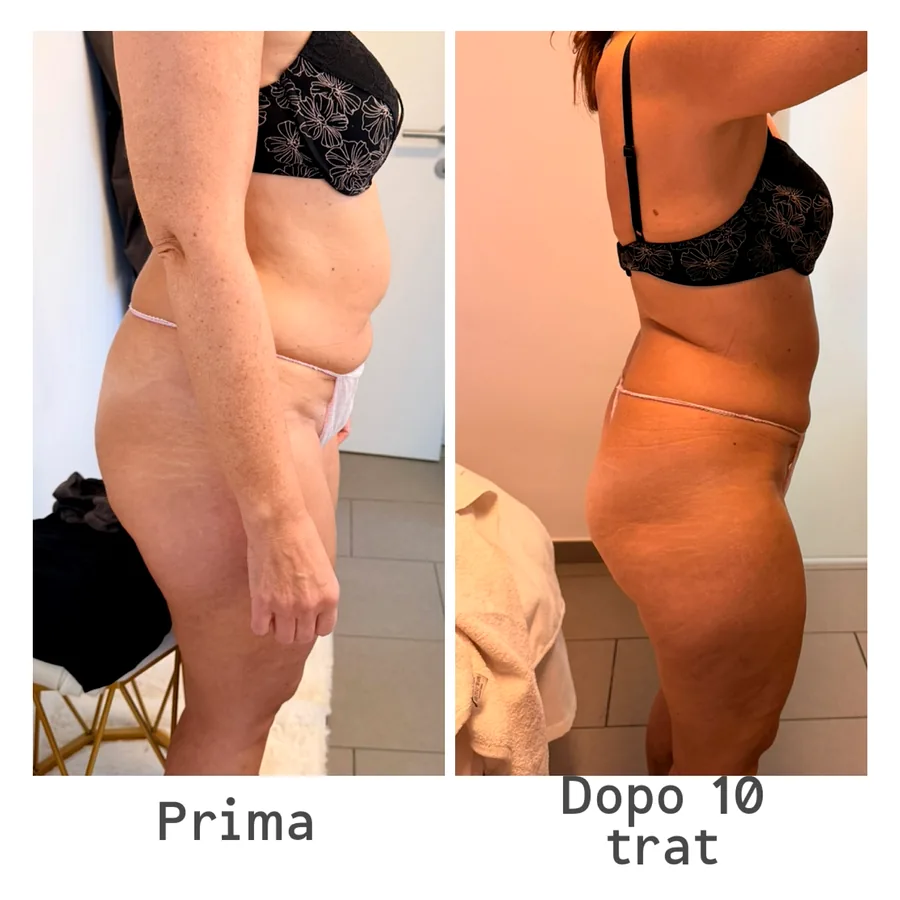 Prima e dopo i nostri percorsi corpo: Trattamenti anticellulite personalizzati — Estetica Beauty & Care