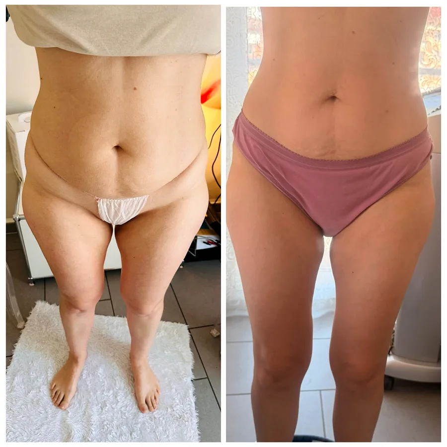 Prima e dopo i nostri percorsi corpo: Criolipolisi (Cryo e talasso) — Estetica Beauty & Care